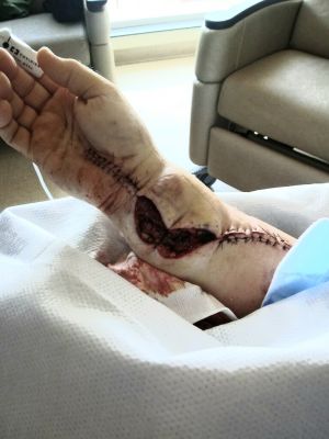 20190922_175710
Wrist swollen to much to close.  2 day wait for swelling to go down.
