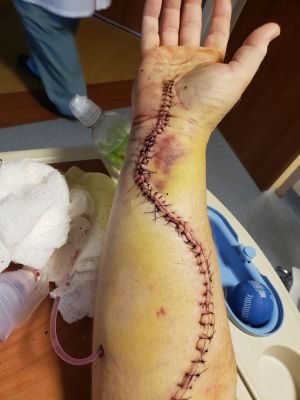 20190925_094956a
Arm after 3rd Surgery
