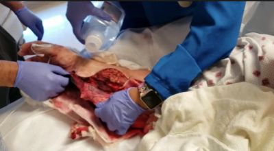 Arm Cleaning
GRAPHIC VIDEO CAN BE FOUND HERE: 

http://arm.goldsmithclan.net/1VID20190919.mp4
